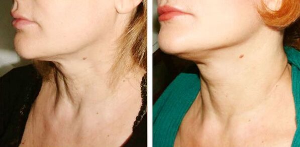 before and after laser skin rejuvenation Figure 1