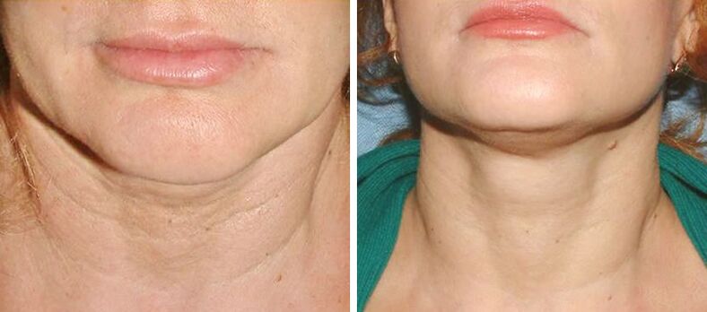 before and after laser skin rejuvenation Figure 2