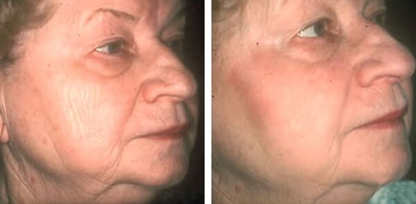 before and after laser skin rejuvenation Figure 4