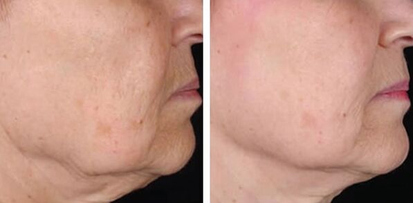 before and after skin rejuvenation with laser Figure 3