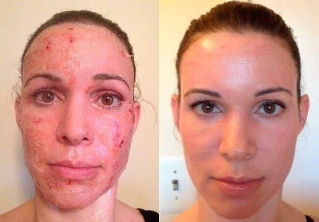 Photo 1 before and after fractional skin rejuvenation