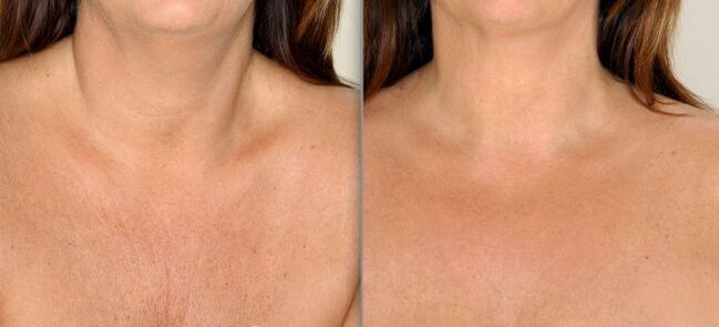 Photo 2 before and after fractional skin rejuvenation