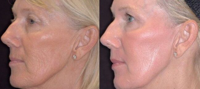 Photo 3 before and after fractional skin rejuvenation