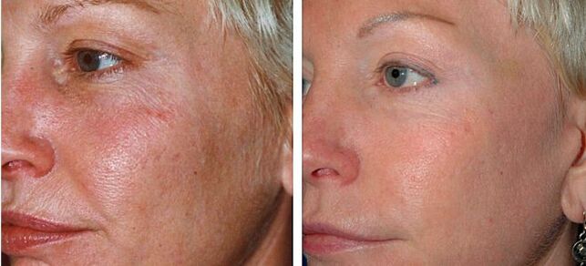 Photo 4 before and after fractional skin rejuvenation