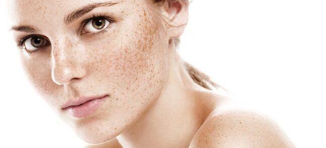 freckles as an indicator of fractional rejuvenation