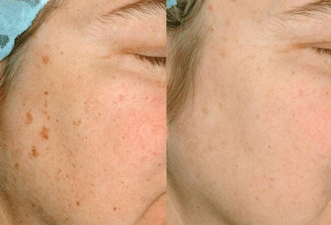 Eliminate skin pigmentation