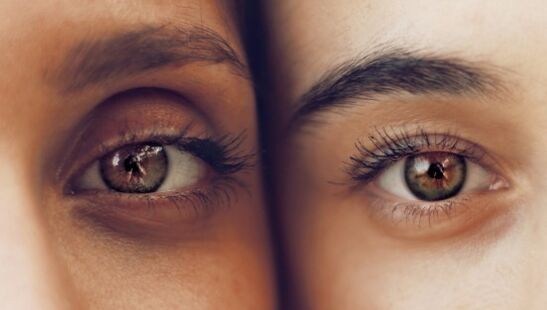 Dark circles beneath the eyes