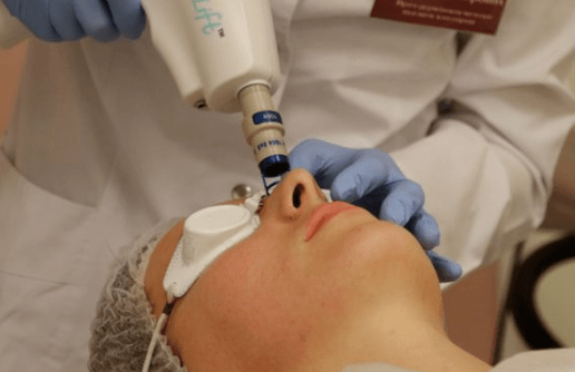Unexplained laser rejuvenation