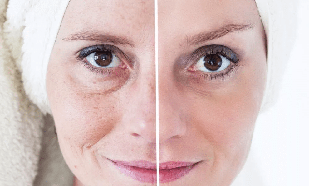 Laser facial rejuvenation